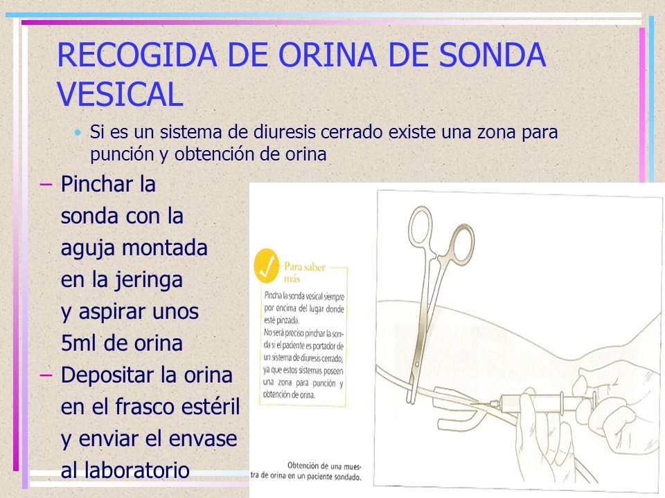 muestra de micción por sonda foley